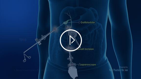 Laparoscopic Gallbladder Surgery