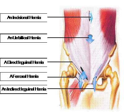 Types of Hernia